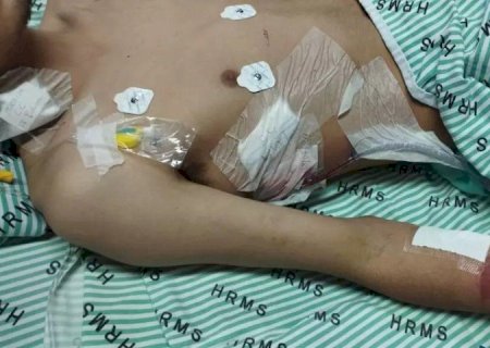 USO DE VAPE E NARGUILE PROVOCA PERDA DE PARTE DE PULMÃO EM JOVEM