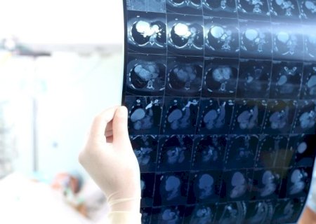 A PEDIDO DO MPMS, ESTADO DEVERÁ ATENDER AOS 25 MIL PACIENTES QUE AGUARDAM EXAMES DE IMAGEM