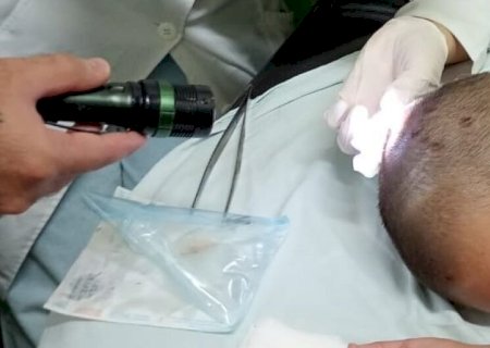 EM DOURADOS, PAI DENUNCIA EX POR MAUS-TRATOS APÓS ENCONTRAR LARVAS NA CABEÇA DA FILHA