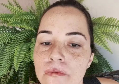 MULHER PERDE OS LÁBIOS AO SER SUBMETIDA A HARMONIZAÇÃO COM SUBSTÂNCIA PROIBIDA