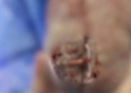 BEBÊ NASCE COM DIU DA MÃE GRUDADO NO CORPO E CHOCA MÉDICA; VEJA IMAGENS