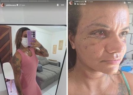 VÍTIMA DE AGRESSÃO COM 61 SOCOS COMPARTILHA ROTINA DE RECUPERAÇÃO NAS REDES SOCIAIS